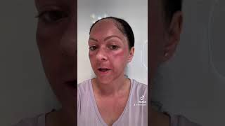 Windyigarn Spicule BioMicroneedling Kit Day 1  Amazing Results By Nature [upl. by Hirza]