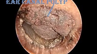 Dried Hemorrhagic Ear Canal Polyp Removal amp Cleaning [upl. by Fionna]