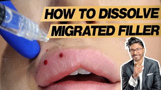 Lip Filler Dissolving Process For Migration In Real Time [upl. by Anileda623]