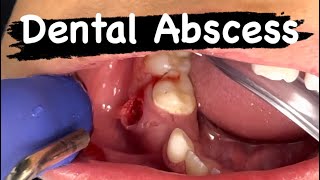 Primary Tooth Dental Abscess [upl. by Ellatnahc106]