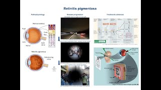 Retinitis pigmentosa pathophysiology and treatment advances [upl. by Scholem138]