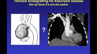 Endovascular Stent Grafting for ascending and aortic arch repair by John Ikonomidis MD Part 2mov [upl. by Nebur]