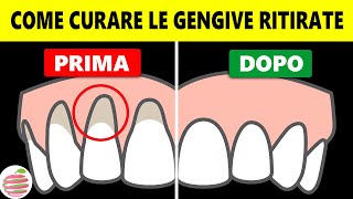 Come Trattare Le Gengive Ritirate A Casa In Modo Naturale [upl. by Emlyn298]