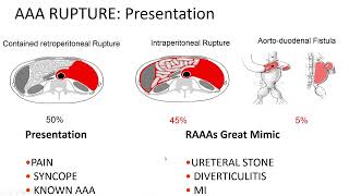 Webinar  Ruptured Abdominal Aortic Aneurysm  ANGIO Mentor  29102015 [upl. by Adyht]