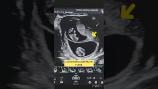 “Key Ultrasound Findings in Dichorionic Diamniotic Twins” [upl. by Odla]