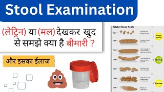 लेट्रीन या मल देखकर समझे क्या है बीमारी और ईलाज  Stool Examination and treatment [upl. by Ostap800]