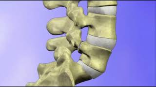 Spondylolisthesis explained [upl. by Idur]