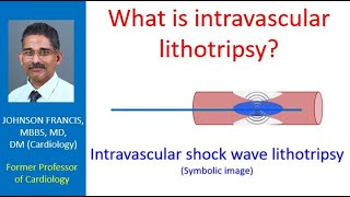 What is intravascular lithotripsy [upl. by Sinoda]