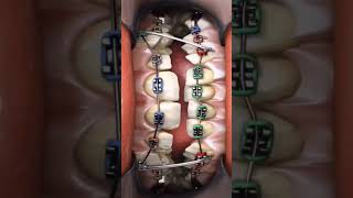 OMG Orthodontic treatment Before ampAfter Yrs of transition in just few secs viralvideo ytshorts [upl. by Atinuhs]