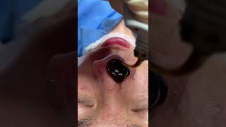 Remove Blackheads on Nose with a PeelOff Mask  Try It Now [upl. by Kipper]