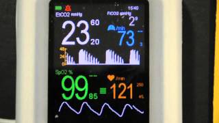 Cardiogenic Oscillations on VM2500M capnograph pulse oximeter [upl. by Gnauq13]