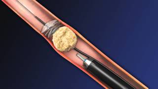 CoAx 10mm Stone Control Catheter from Accordion Medical [upl. by Stew485]