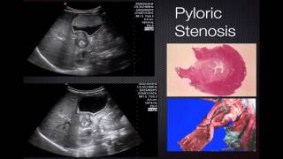 Ultrasond in Pathology  Pyloric Stenosis [upl. by Barabas]