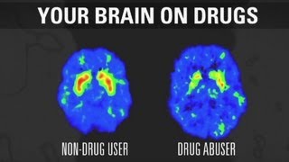 How addiction changes your brain [upl. by Tine]