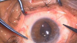 Traumatic membranes Iris sutured IOL  Pupiloplasty Lukan Mishev Live Stream [upl. by Elleinwad]