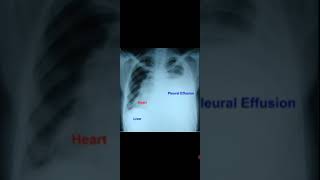 Left Sided Pleural Effusion with Dextroposition of HeartAwerenes of All [upl. by Emmye]