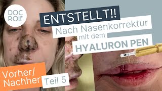 NASENKORREKTUR mit dem HYALURON PEN entstellt Snezanas Gesicht 😱 Teil 5 – docrolf [upl. by Annatsirhc730]