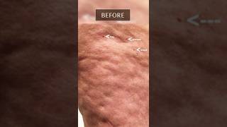 JawDropping Fascia Blaster Cellulite Before amp After [upl. by Norga]