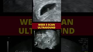 Debunking Ultrasound Myths The Truth Behind Sonograms vs Ultrasounds [upl. by Kevyn]