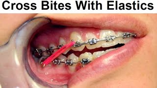 Correcting Cross Bite Using Orthodontic Elastics by Dr Mike Mew [upl. by Coleville]