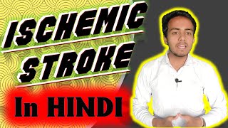 Ischemic Stroke इस्कीमिक स्ट्रोक ब्रेन स्ट्रोक Detailed In Hindi By SahilMittal MEP [upl. by Didi212]