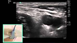 UltrasoundGuided Femoral Nerve Block  SonoSitemp4 [upl. by Addiel]