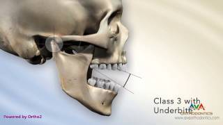 Malocclusion  Underbite or Crossbite Secondary to Short Maxillary Height [upl. by Onirotciv]