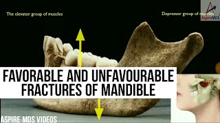 Favorable and Unfavorable Fracture of Mandible  Reupload without BGM  ASPIRE MDS [upl. by Kalle]