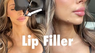 I Got Lip Filler VLOG  What You Need to Know [upl. by Raff809]