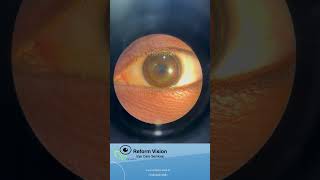 Keratoconus Clinic in Hyderabad  Reform Vision  Rose K2 contact lens Clinic in Hyderabad  Vision [upl. by Ydissac]