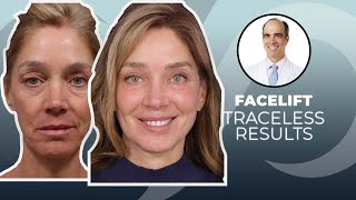 10 YEARS YOUNGER Traceless Facelift Surgery Before and After  Dr David Stoker [upl. by Nylauqcaj]