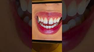 Fechamento de Diastema em Resina Composta pela Dra Daiane Souza [upl. by Ahsied220]