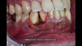 Oral Pyogenic Granuloma Treatment in Bangalore  Dental Solutions Bangalore [upl. by Otho]