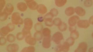 Plasmodium malaria gametocytes [upl. by Hajin132]