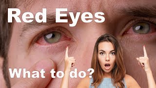 Bloodshot Eyes What to do How to treat Eye Redness and Home Remedies [upl. by Littlejohn]