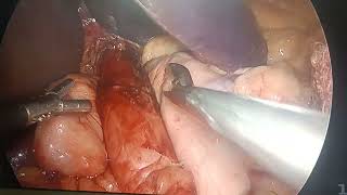 laproscopy fundoplication [upl. by Gathard]