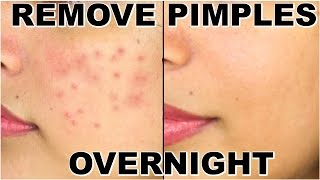 How To Remove Pimples Overnight  Acne Treatment  ShrutiArjunAnand [upl. by Hansen187]