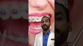 🤷‍♂️Teeth Gap Treatment dentist dentalclinic teethgapmakeover [upl. by Egiap]