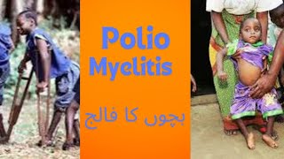 Polio myelitis [upl. by Onairelav276]