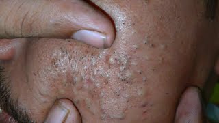 sac be spa blackheads elderly 2025  sac be spa boy age blackheads 2025  ASMR sac be spa scrub 660 [upl. by Nyltiac]