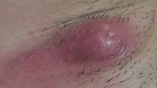 how to get rid of a boil under your armpit easy in 1 day [upl. by Einatirb]