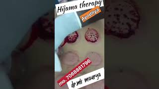 Hijama therapy and cupping therapy treatment for body detoxHow it works [upl. by Asilef]