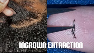 Super Satisfying Ingrown amp Compound Hair Extraction From Beard [upl. by Asihtal]