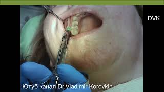 Infiltration anesthesia for treatment 14 toothlocalanaesthesia nerveblock [upl. by Edualc]