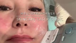 HIFU Treatment  Skincare Laser Clinic  Point Cook Melbourne [upl. by Enywtna]