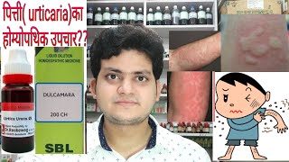 Urticaria Homeopathic medicine for Urticaria explain [upl. by Surazal]