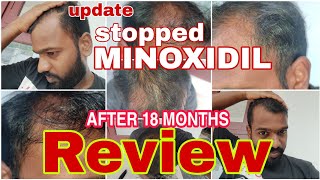 Reviewing the effect of minoxidil mintop 10 after 18 months from the day i stopped using itResul [upl. by Simons]