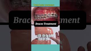 Braces Results braces bracesoff [upl. by Eentirb]