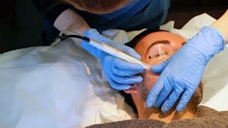 Microdermabrasion with Stuart  The Laser and Skin Clinic [upl. by Llyrehc]