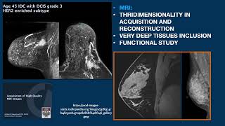 COMPARISON BETWEEN BMRI MAMMOGRAPHY DBT AND CESM [upl. by Burford]